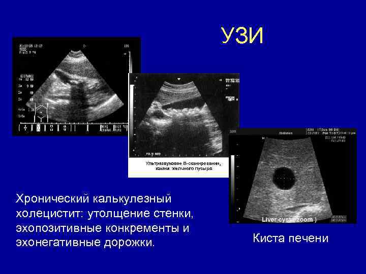 УЗИ Хронический калькулезный холецистит: утолщение стенки, эхопозитивные конкременты и эхонегативные дорожки. Киста печени 