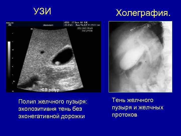 УЗИ Полип желчного пузыря: эхопозитивня тень без эхонегативной дорожки Холеграфия. Тень желчного пузыря и