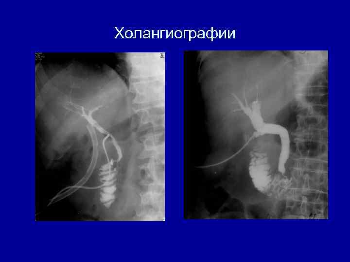 Холангиографии 