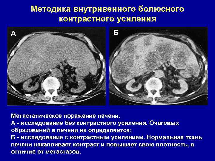 Метастатические поражения печени в ультразвуковом изображении характеризуются