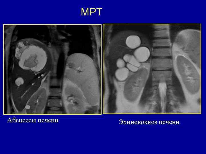 МРТ Абсцессы печени Эхинококкоз печени 