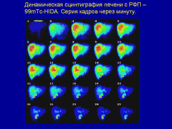 Динамическая сцинтиграфия печени с РФП – 99 m. Tc-HIDA. Серия кадров через минуту. 