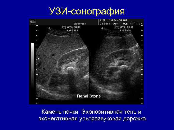 УЗИ-сонография Камень почки. Эхопозитивная тень и эхонегативная ультразвуковая дорожка. 