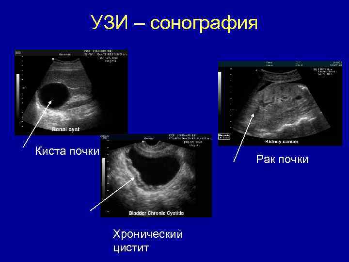 УЗИ – сонография Киста почки Рак почки Хронический цистит 