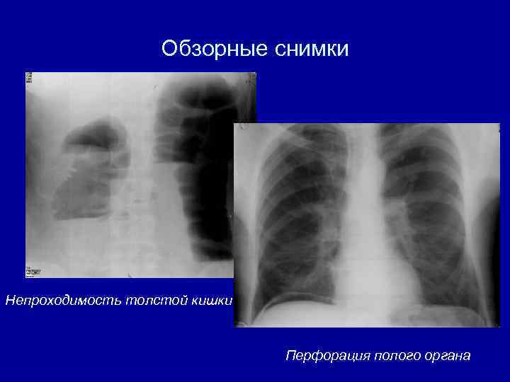 Прободение полого органа рентген схема