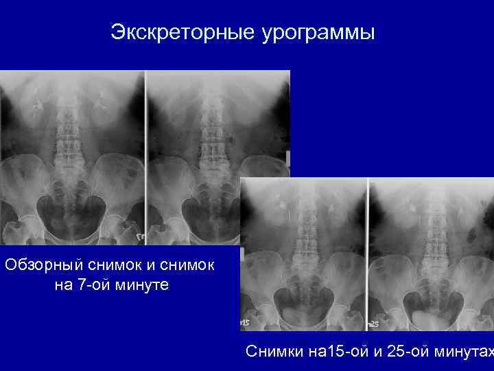 Экскреторные урограммы Обзорный снимок и снимок на 7 -ой минуте Снимки на 15 -ой