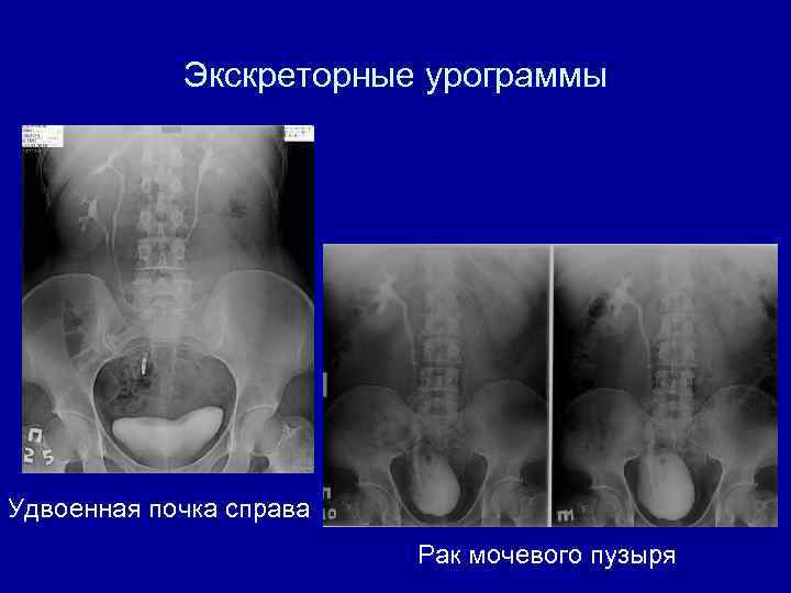 Экскреторная урография презентация