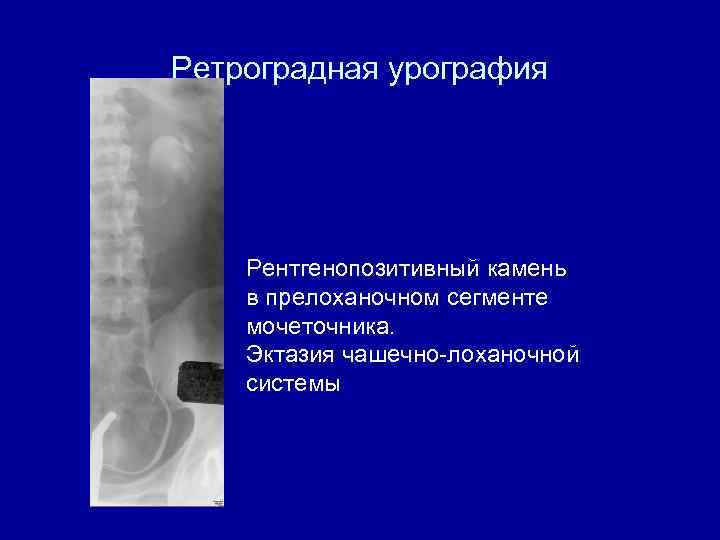 Ретроградная урография Рентгенопозитивный камень в прелоханочном сегменте мочеточника. Эктазия чашечно-лоханочной системы 