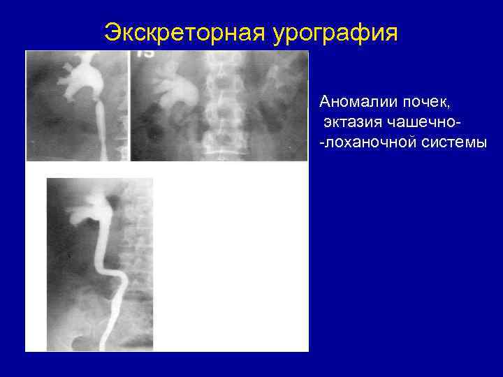 Экскреторная урография Аномалии почек, эктазия чашечно-лоханочной системы 