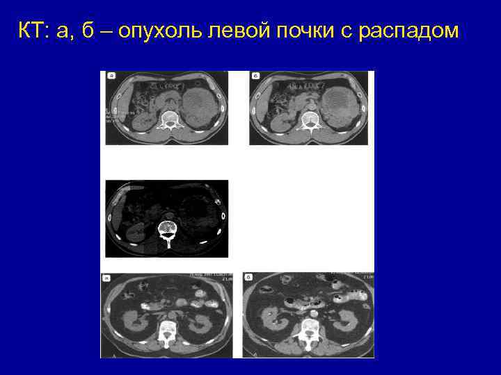 КТ: а, б – опухоль левой почки с распадом 
