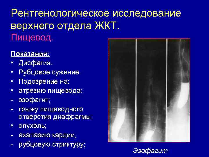 Рентгенологическое исследование верхнего отдела ЖКТ. Пищевод. Показания: • Дисфагия. • Рубцовое сужение. • Подозрение