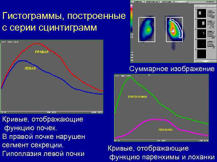Гистограммы, построенные с серии сцинтиграмм Суммарное изображение Кривые, отображающие функцию почек. В правой почке