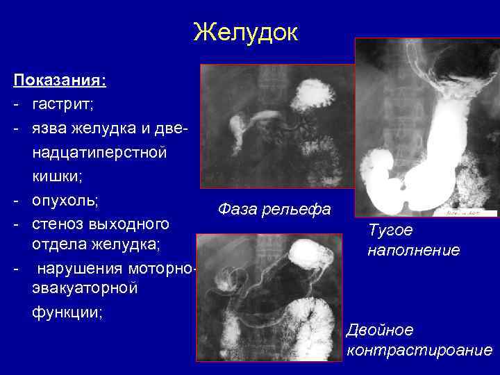 Желудок Показания: - гастрит; - язва желудка и двенадцатиперстной кишки; - опухоль; - стеноз