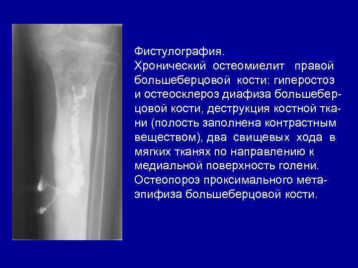 Фистулография. Хронический остеомиелит правой большеберцовой кости: гиперостоз и остеосклероз диафиза большеберцовой кости, деструкция костной