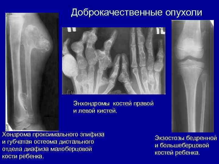 Доброкачественные опухоли Энхондромы костей правой и левой кистей. Хондрома проксимального эпифиза и губчатая остеома