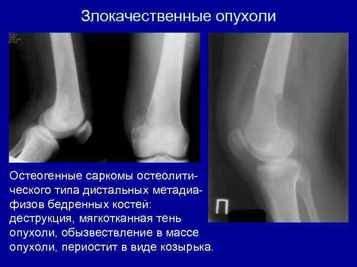 Злокачественные опухоли Остеогенные саркомы остеолитического типа дистальных метадиафизов бедренных костей: деструкция, мягкотканная тень опухоли,