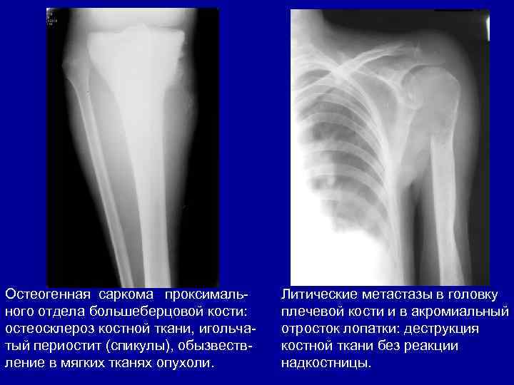 Остеогенная саркома проксимального отдела большеберцовой кости: остеосклероз костной ткани, игольчатый периостит (спикулы), обызвествление в