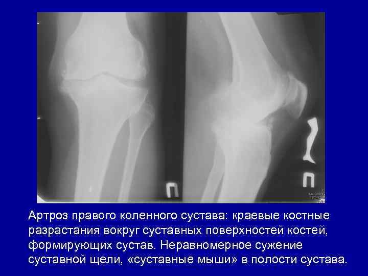 , неравномерное сужение Артроз правого коленного сустава: краевые костные разрастания вокруг суставных поверхностей костей,