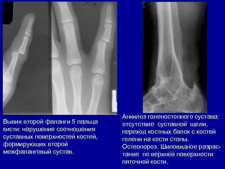 Вывих второй фаланги 5 пальца кисти: нарушение соотношения суставных поверхностей костей, формирующих второй межфаланговый