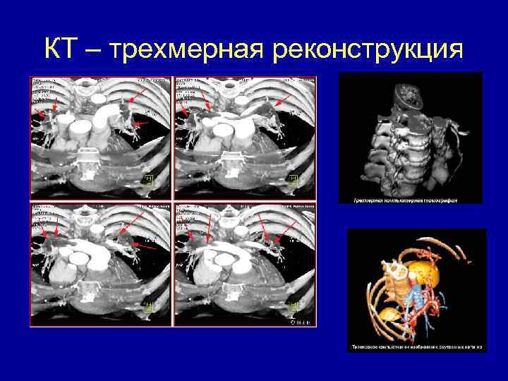 КТ – трехмерная реконструкция 