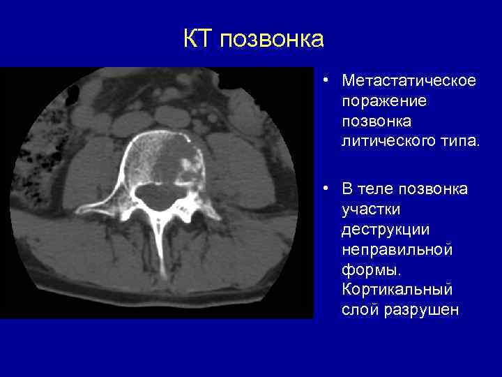 КТ позвонка • Метастатическое поражение позвонка литического типа. • В теле позвонка участки деструкции