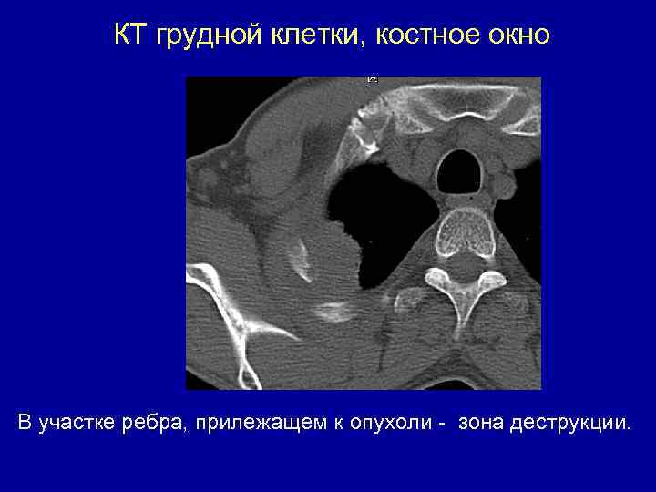 КТ грудной клетки, костное окно В участке ребра, прилежащем к опухоли - зона деструкции.