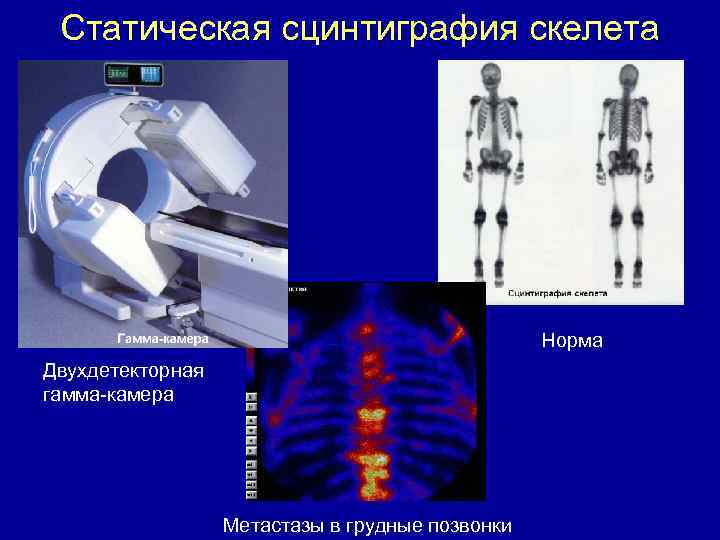 Статическая сцинтиграфия скелета Норма Двухдетекторная гамма-камера Метастазы в грудные позвонки 