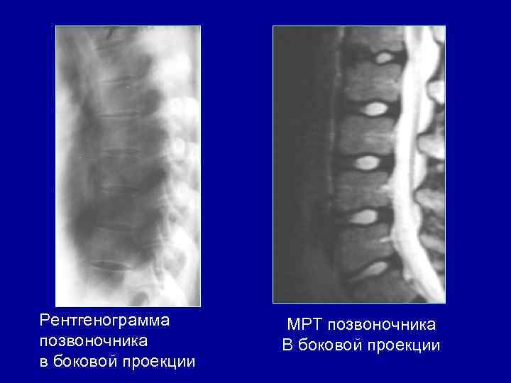 Рентгенограмма позвоночника в боковой проекции МРТ позвоночника В боковой проекции 