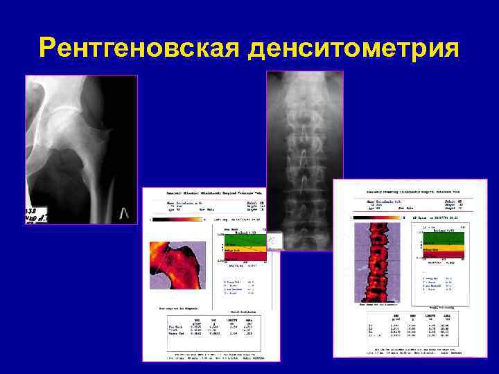 Рентгеновская денситометрия 