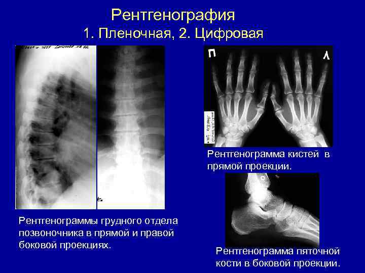 Рентгенография 1. Пленочная, 2. Цифровая Рентгенограмма кистей в прямой проекции. Рентгенограммы грудного отдела позвоночника