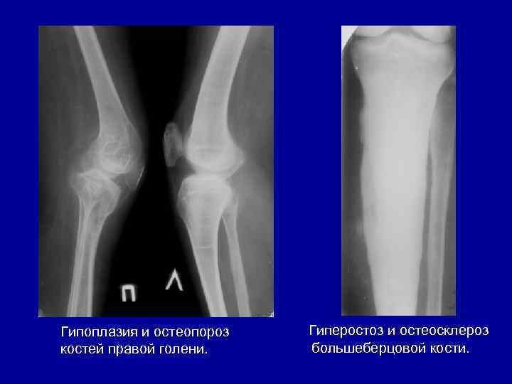 Гипоплазия и остеопороз костей правой голени. Гиперостоз и остеосклероз большеберцовой кости. 