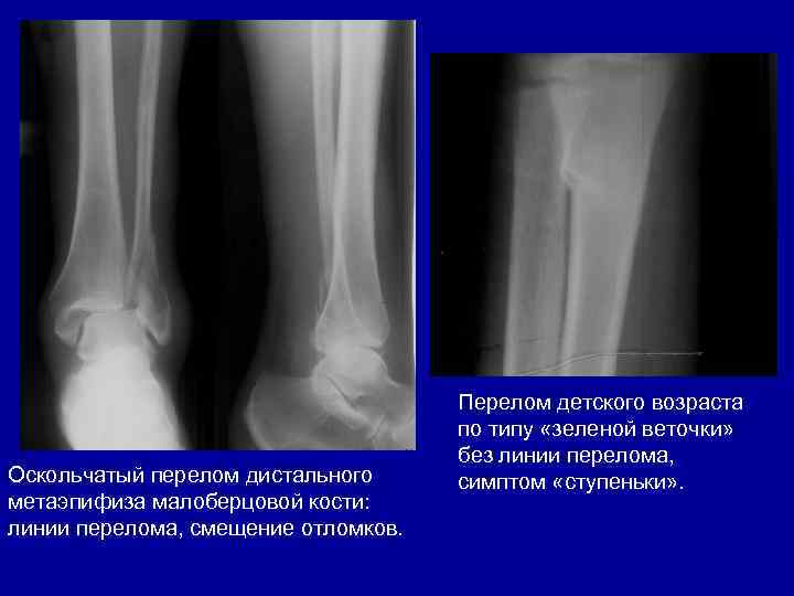 Оскольчатый перелом дистального метаэпифиза малоберцовой кости: линии перелома, смещение отломков. Перелом детского возраста по