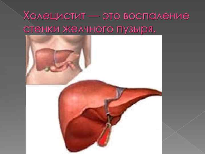 Холецистит — это воспаление стенки желчного пузыря. 