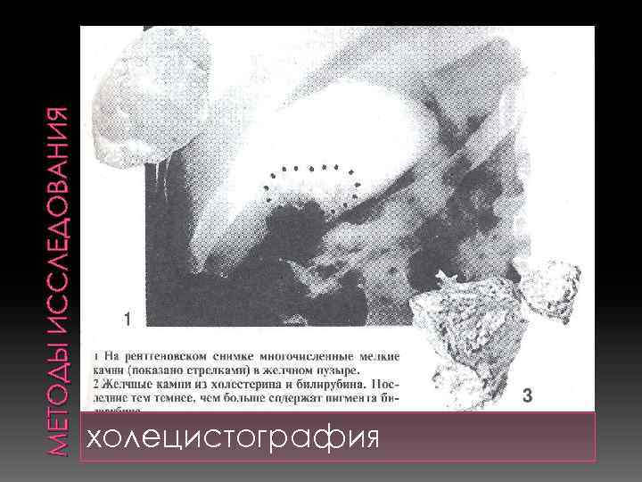 МЕТОДЫ ИССЛЕДОВАНИЯ холецистография 