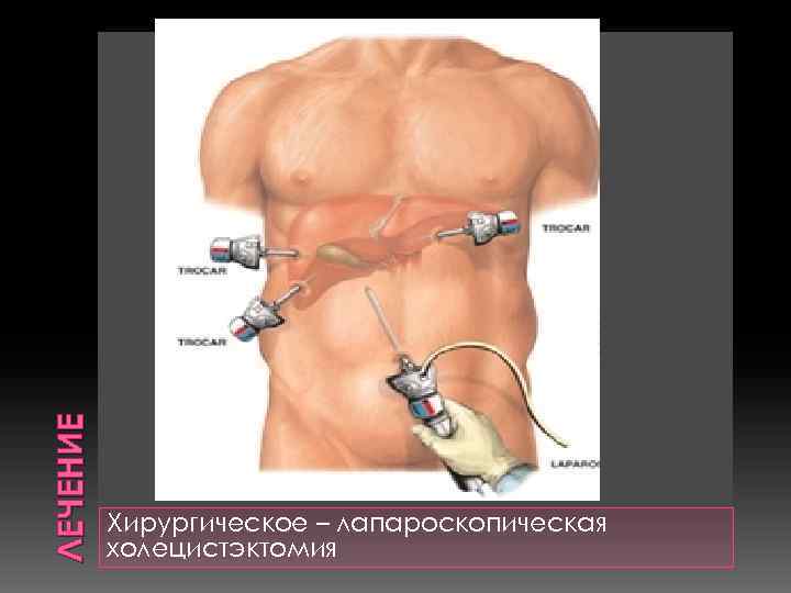 ЛЕЧЕНИЕ Хирургическое – лапароскопическая холецистэктомия 