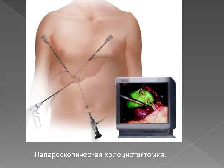 Лапароскопическая холецистэктомия. 