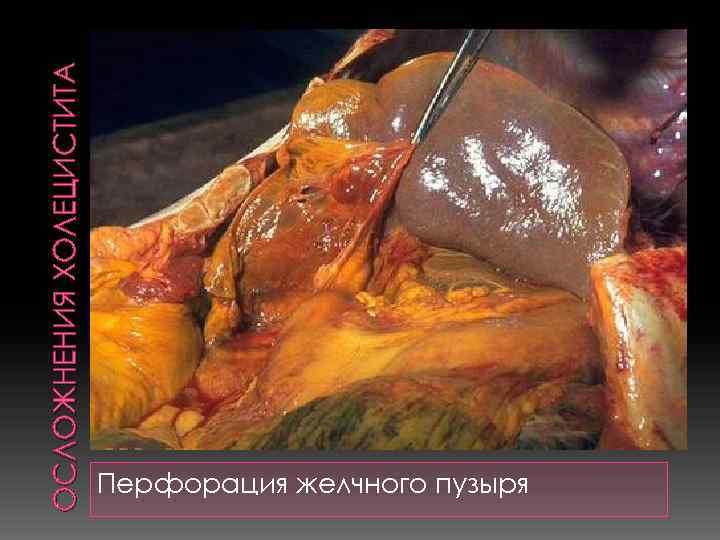 ОСЛОЖНЕНИЯ ХОЛЕЦИСТИТА Перфорация желчного пузыря 