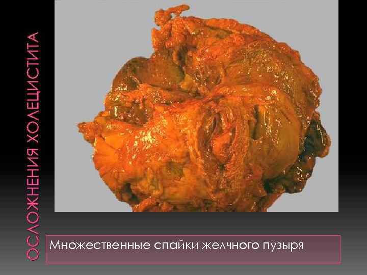 ОСЛОЖНЕНИЯ ХОЛЕЦИСТИТА Множ естве нные спайк и желчн ого пузыр я; макро препа рат.