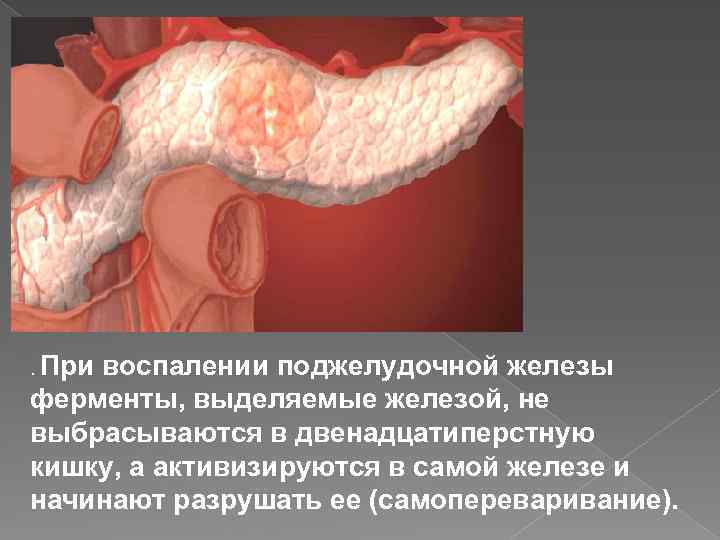 . При воспалении поджелудочной железы ферменты, выделяемые железой, не выбрасываются в двенадцатиперстную кишку, а