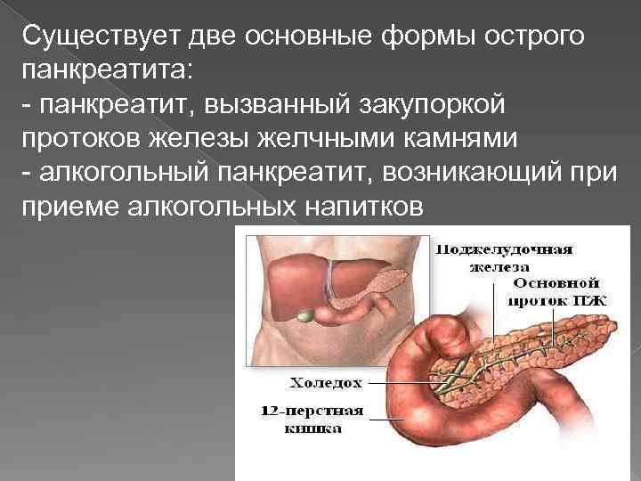 Существует две основные формы острого панкреатита: - панкреатит, вызванный закупоркой протоков железы желчными камнями