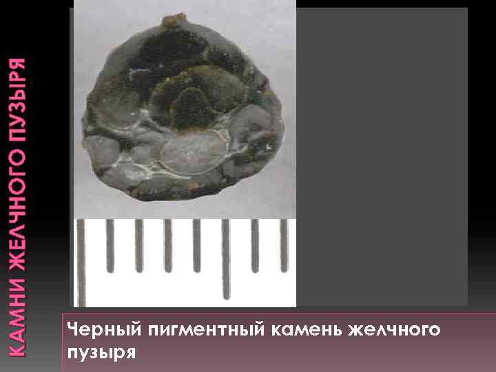 КАМНИ ЖЕЛЧНОГО ПУЗЫРЯ Черный пигментный камень желчного пузыря 