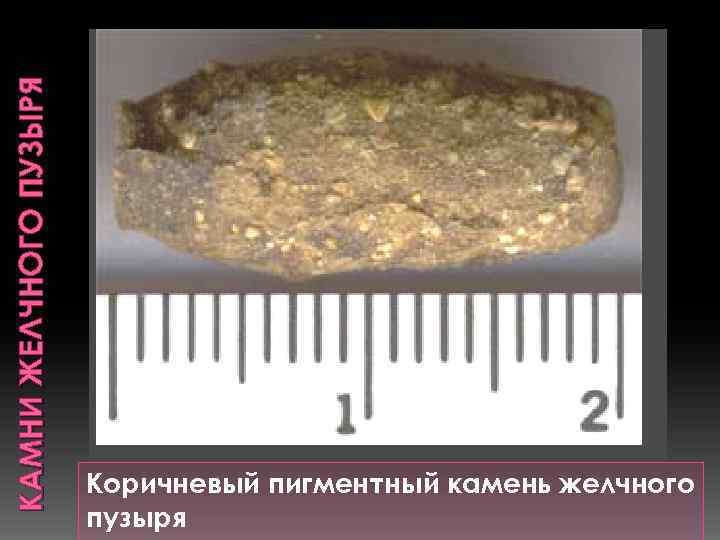 КАМНИ ЖЕЛЧНОГО ПУЗЫРЯ Коричневый пигментный камень желчного пузыря 