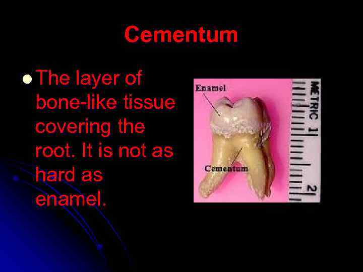 Cementum l The layer of bone-like tissue covering the root. It is not as