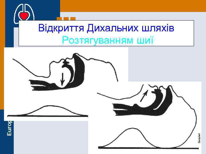 Campbell European Resuscitation Council Відкриття Дихальних шляхів Розтягуванням шиї 