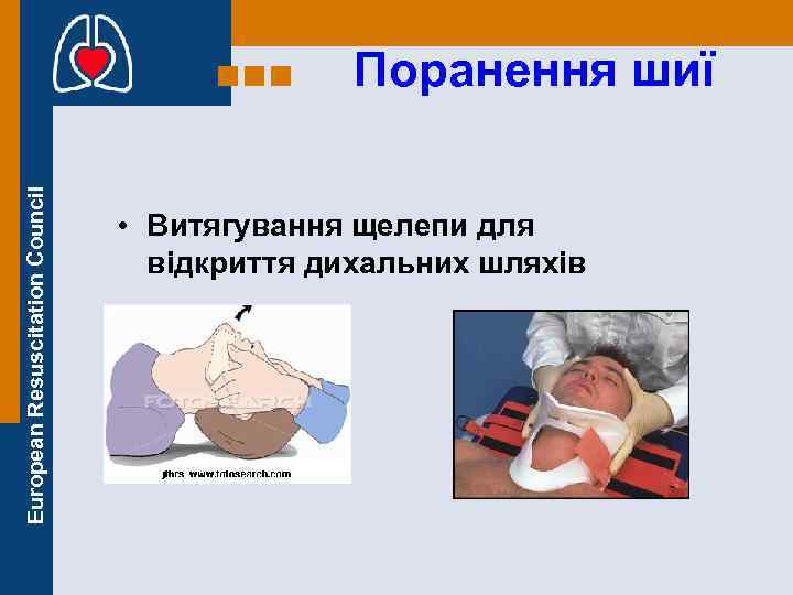 European Resuscitation Council Поранення шиї • Витягування щелепи для відкриття дихальних шляхів 