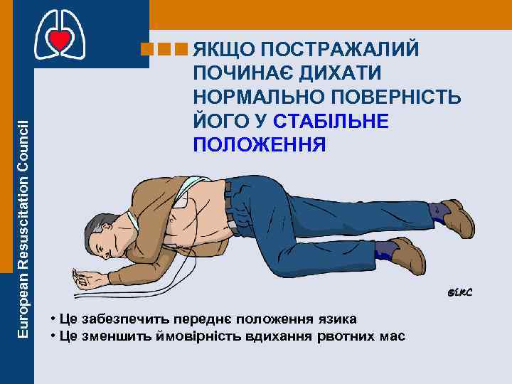 European Resuscitation Council ЯКЩО ПОСТРАЖАЛИЙ ПОЧИНАЄ ДИХАТИ НОРМАЛЬНО ПОВЕРНІСТЬ ЙОГО У СТАБІЛЬНЕ ПОЛОЖЕННЯ •