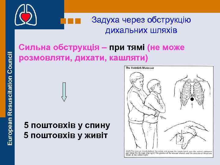 European Resuscitation Council Задуха через обструкцію дихальних шляхів Сильна обструкція – при тямі (не