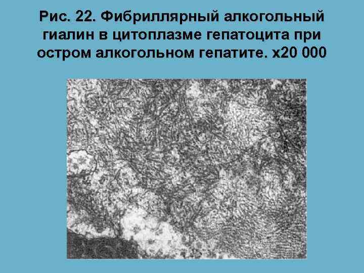 Рис. 22. Фибриллярный алкогольный гиалин в цитоплазме гепатоцита при остром алкогольном гепатите. х20 000