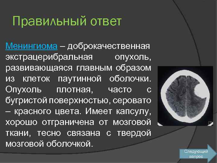 Правильный ответ Менингиома – доброкачественная экстрацерибральная опухоль, развивающаяся главным образом из клеток паутинной оболочки.