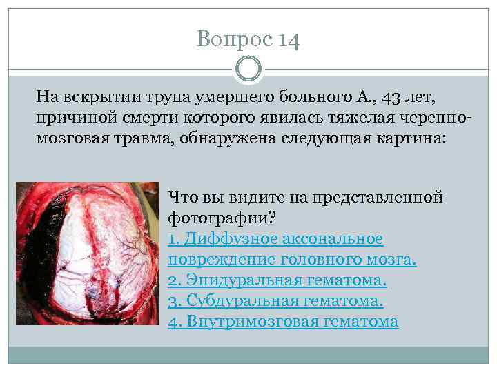 Вопрос 14 На вскрытии трупа умершего больного А. , 43 лет, причиной смерти которого